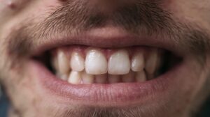 Close-up of a person smiling with visible front teeth.
